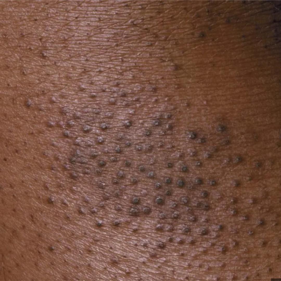Close-up illustration of keratosis pilaris on deep brown skin showing small hyperpigmented follicular bumps