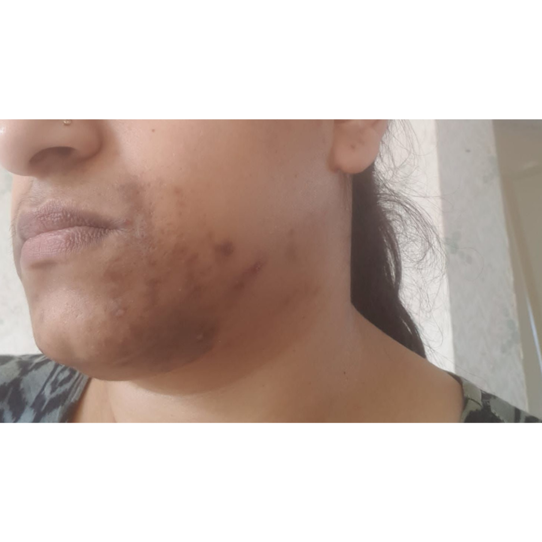 Hyperpigmentation Around The Mouth