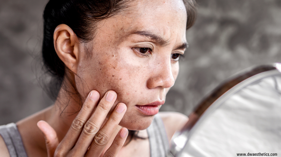 Understanding Melasma: Causes, Treatments and What Actually Works on Melanated Skin