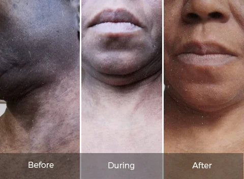 How to Get Rid of Uneven Skin Tone on Melanated Skin