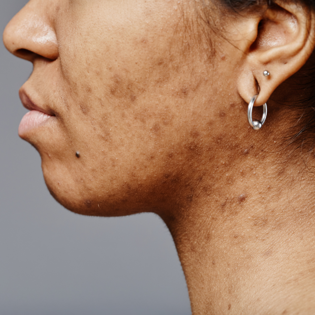 What Does Acne Prone Skin Mean? A Complete Guide for Melanated Skin